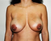 Feel Beautiful - Breast Revision San Diego 15 - After Photo
